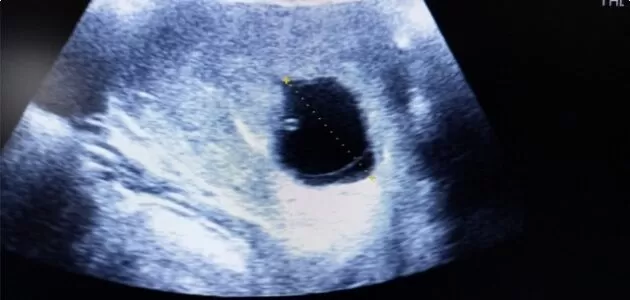 شكل كيس الحمل بعد الإجهاض