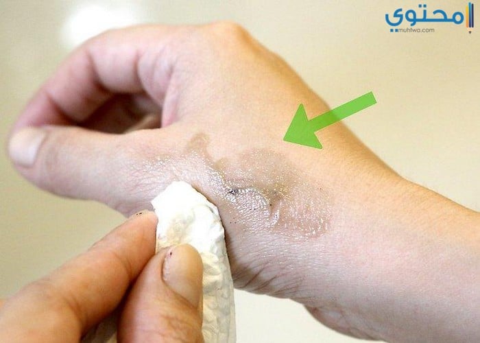aid1252395 v4 728px Remove Dye from Skin Step 1 Version 3