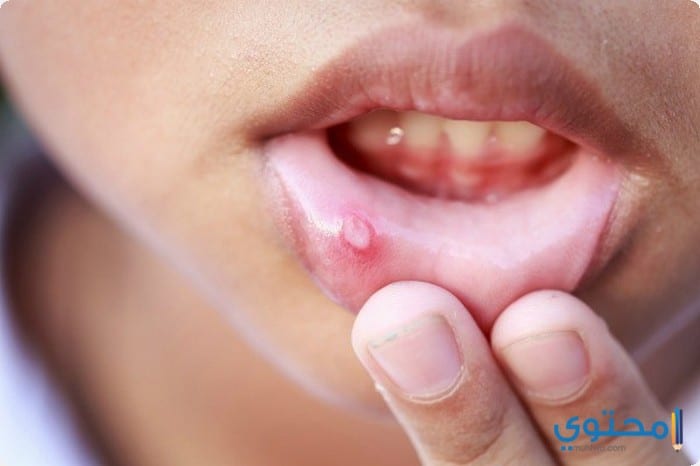 أسباب التهاب الفم