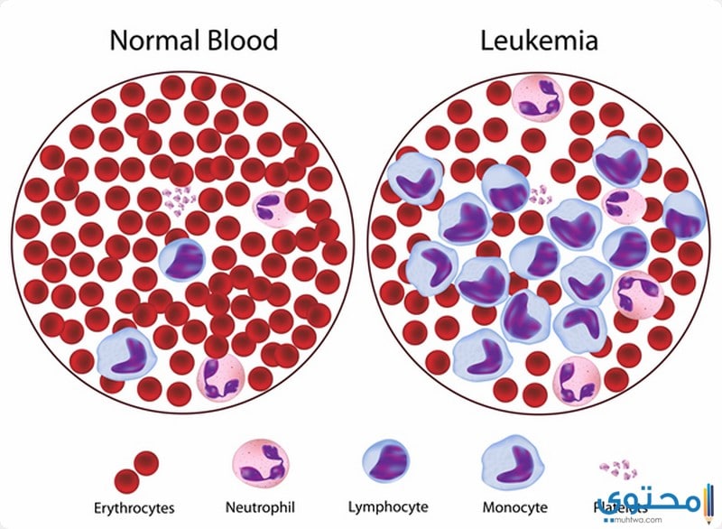 أنواع سرطان الدم