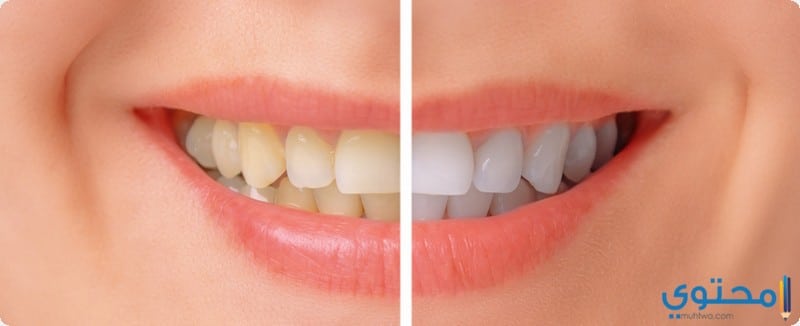طرق علاج اصفرار الأسنان بوصفات منزلية