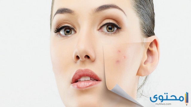 علاج البقع البنية في الوجه