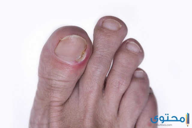 التهاب اصبع القدم الكبير
