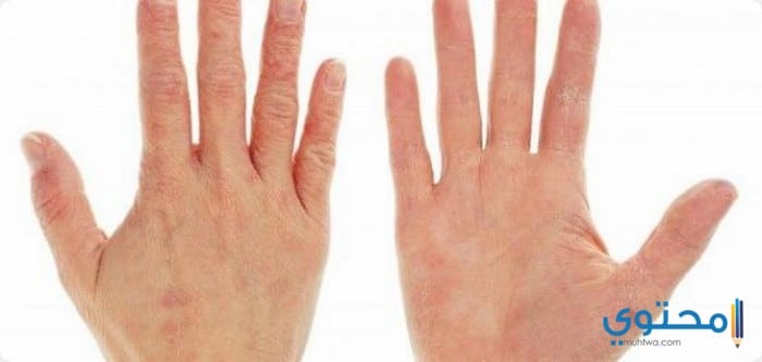 علاج جفاف وخشونة اليدين