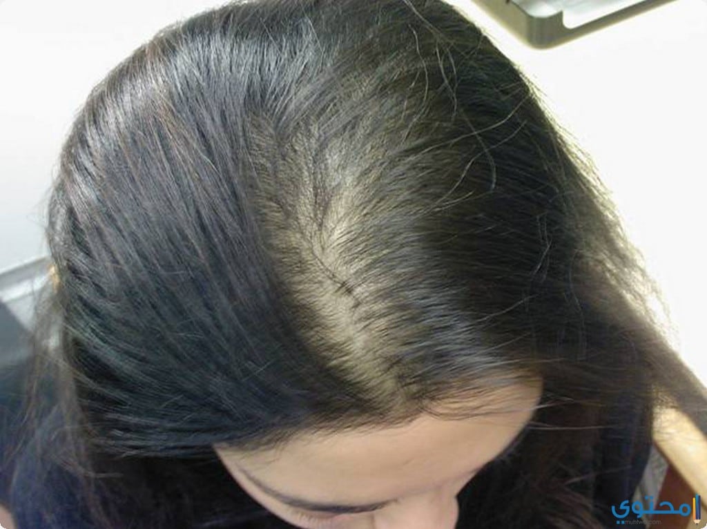علاج صلع الشعر عند النساء