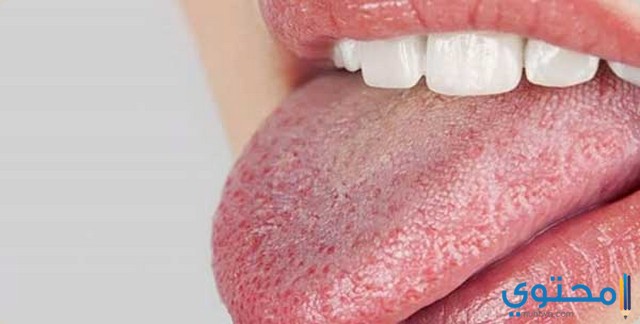 اسماء ادوية لعلاج فطريات الفم