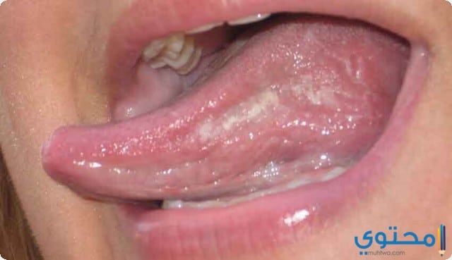أنواع قرحة الفم