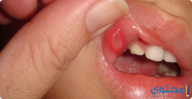 أعراض قرحة الفم